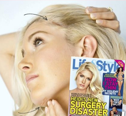 heidi montag chirurgia Heidi Montag: La chirurgia plastica mi ha rovinato la vita