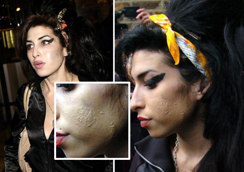 amypelle Amy Winehouse ha lImpetigo
