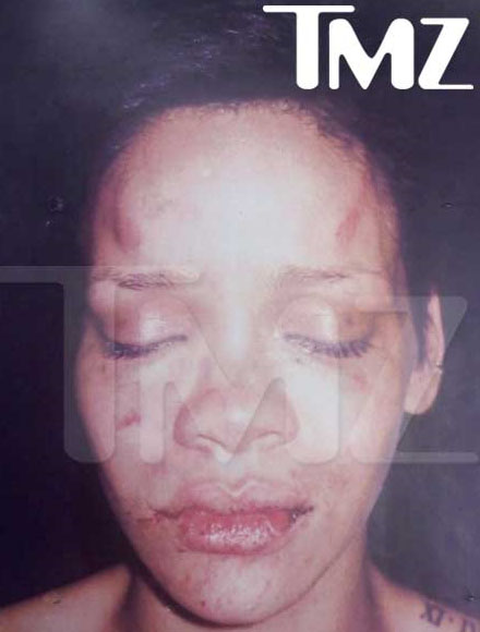 rihannatmz La foto di Rihanna dopo laggressione di Chris