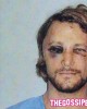 aubry tumefatto1 80x100 Le foto shock di Gabriel Aubry dopo la rissa con Olivier Martinez