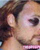 aubry tumefatto2 80x100 Le foto shock di Gabriel Aubry dopo la rissa con Olivier Martinez