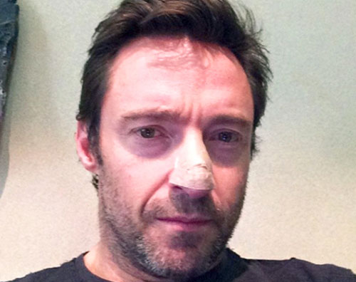 jackman Hugh Jackman rivela: Ho un tumore della pelle