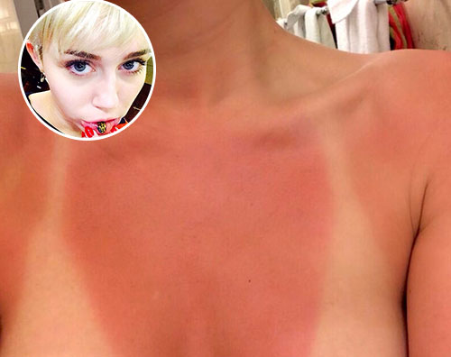 sunburn Scottatura solare per Miley Cyrus