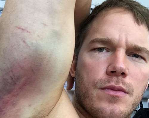 Chris Pratt Chris Pratt tutto muscoli e lividi su Instagram