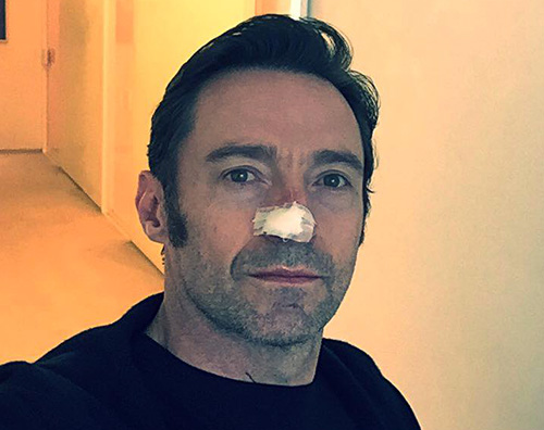 Hugh Jackman Hugh Jackman continua la sua battaglia contro il cancro alla pelle