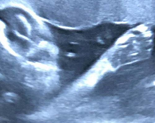 Amy Schumer Amy Schumer sfoggia il suo costume premaman