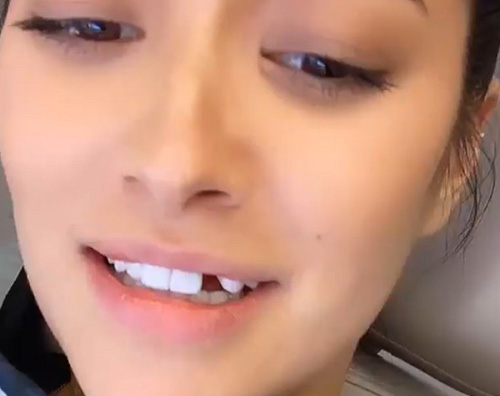 shay Shay Mitchell ha perso un dente