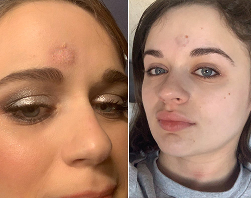 Joey King si è procurata un bernoccolo ai Golden Globes joey king Joey King si è procurata un bernoccolo ai Golden Globes